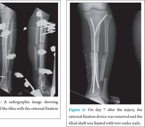 gusilo|Successful treatment of Gustilo type 3C open tibial fracture with a ...